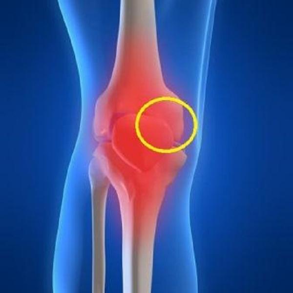 Arthritis: Physical Therapy May Help